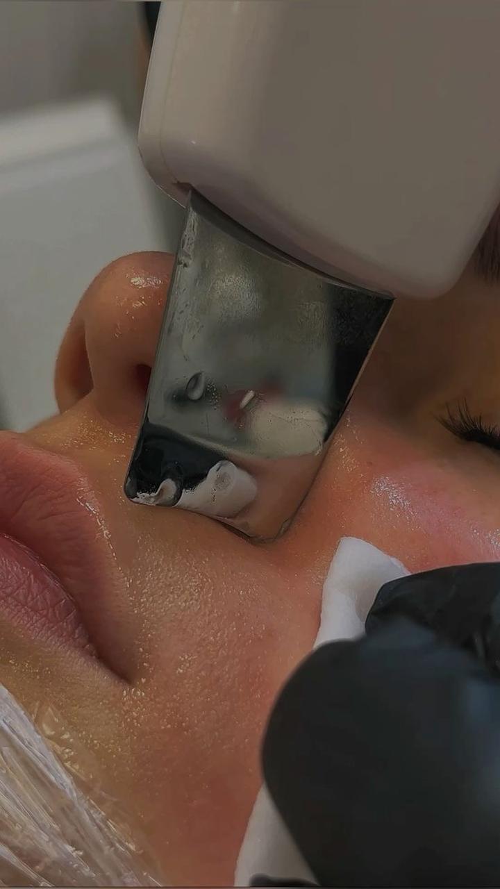 Limpieza Facial con Dermapen y colágeno
